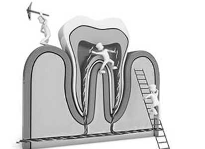 Root Canal Treatment Diagram